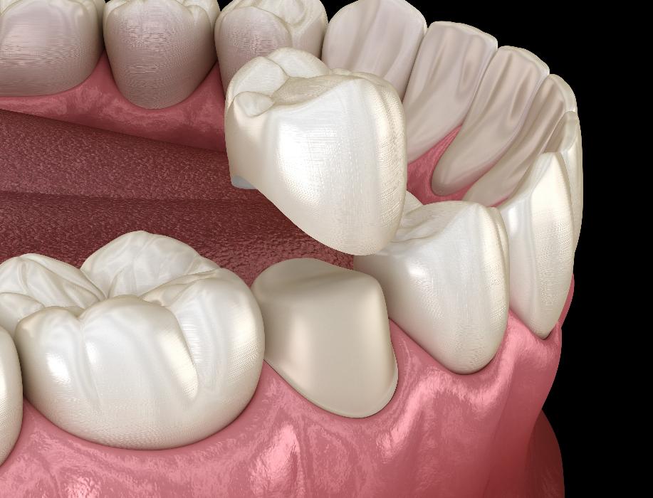same day dental crown fitting in Apex, NC