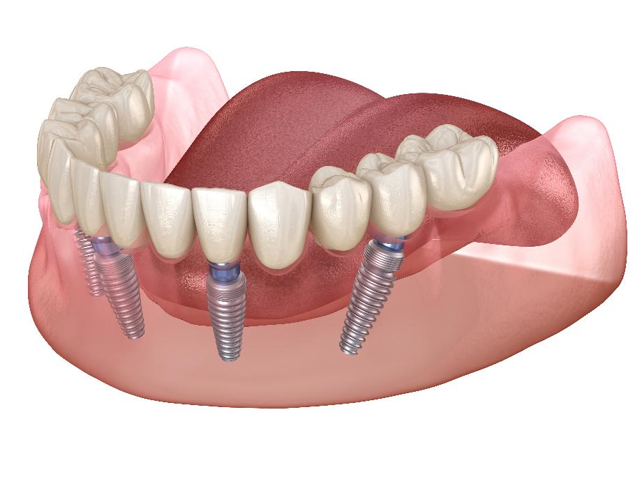 dental implants in apex, nc