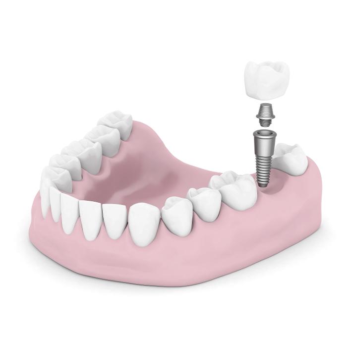 illustration of dental implant going into a jaw