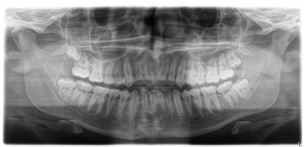 xray | wisdom teeth removal Apex Dentist