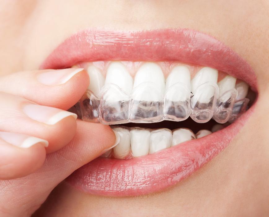 Clear Braces | invisalign in Apex, NC