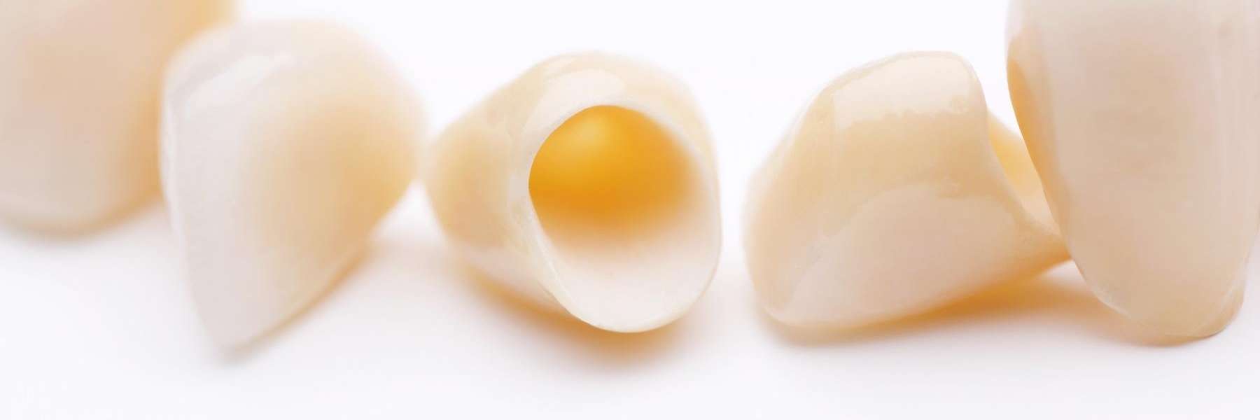 An image of Dental Crowns in Apex, NC