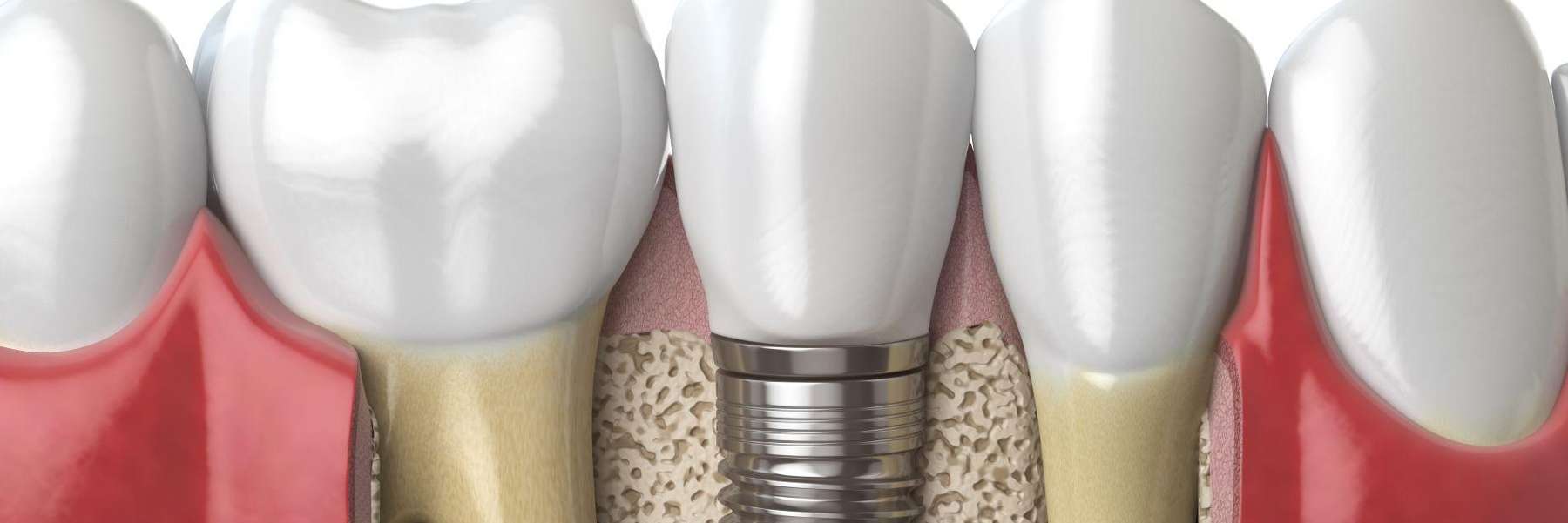 dental implant