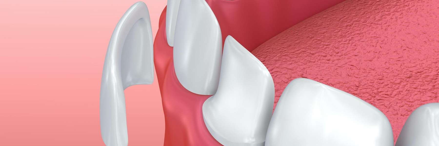 An illustration of a Dental veneers in Apex, NC