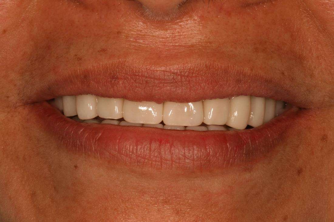woman's bright smile after full smile makeover