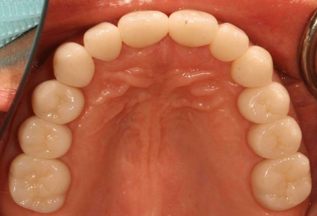 patient's top teeth after getting tooth colored fillings