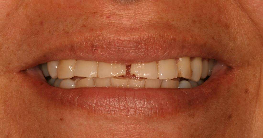 woman's worn front teeth