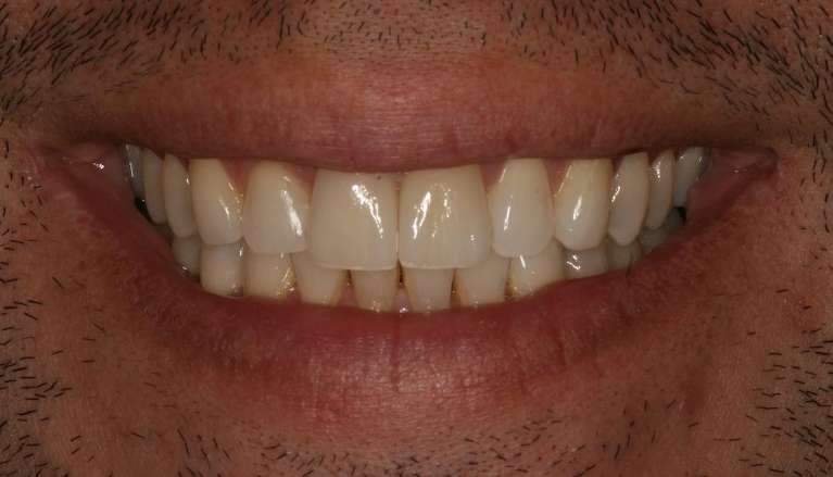 Invisalign-After-Image