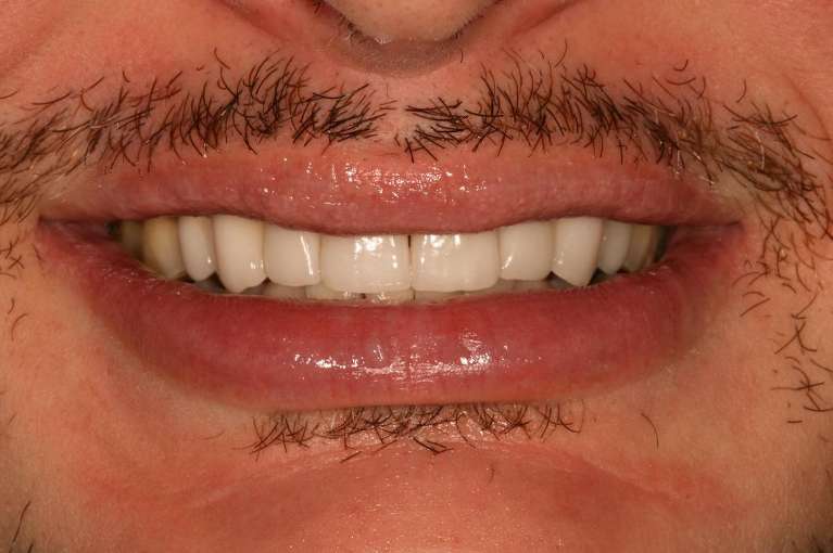 Dental-Implants-After-Image