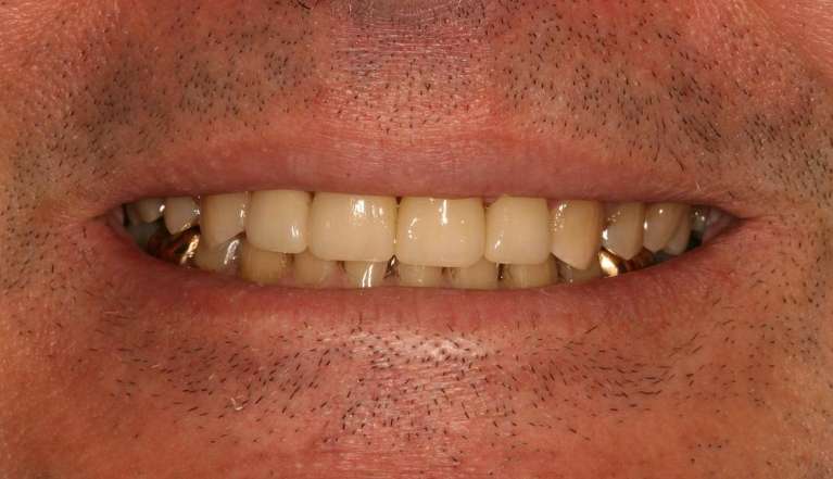 Cosmetic-Dentistry-After-Image