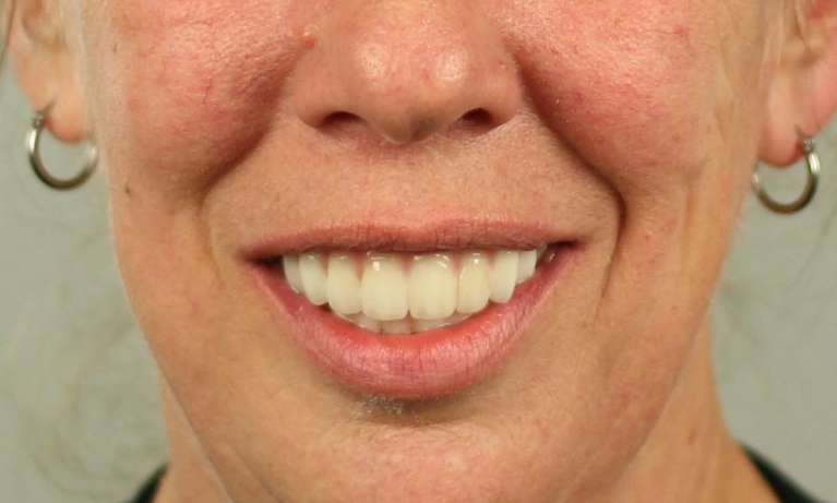 Full-Mouth-Reconstruction-After-Image