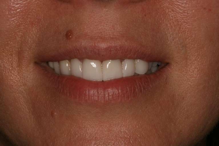 Cosmetic-Dentistry-After-Image