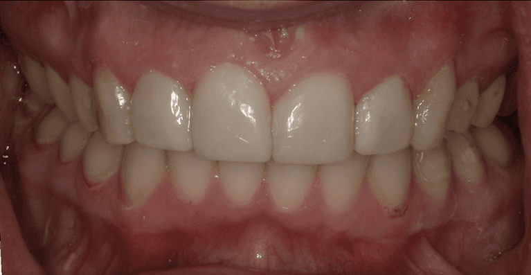 teeth whitening and bonding used to improve this patient's teeth