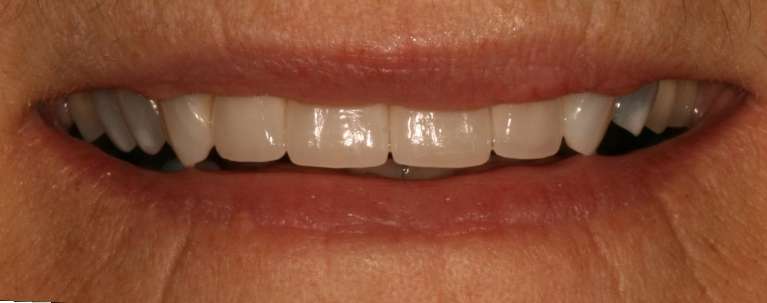 patient's right teeth