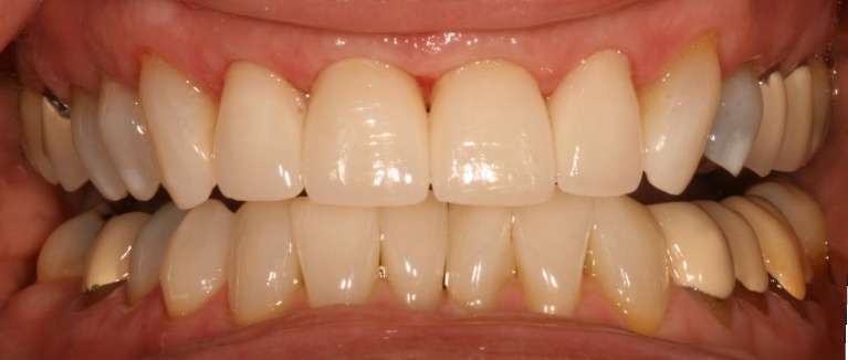 woman's bright smile after dental work in apex nc