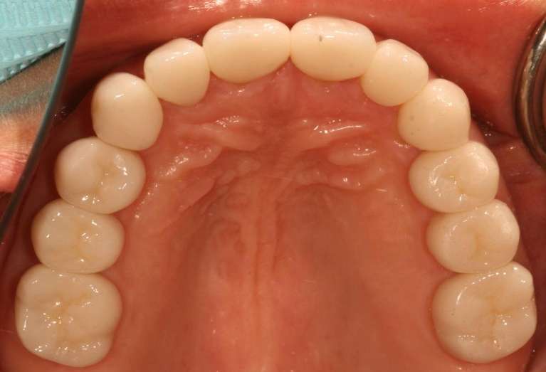 patient's top teeth after getting tooth colored fillings
