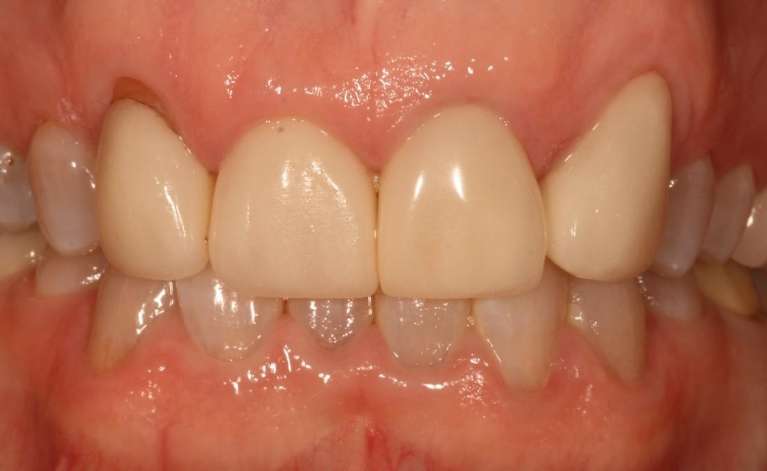 Crowns-Before-Image