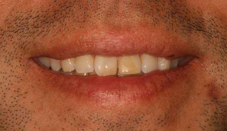 Invisalign-Before-Image