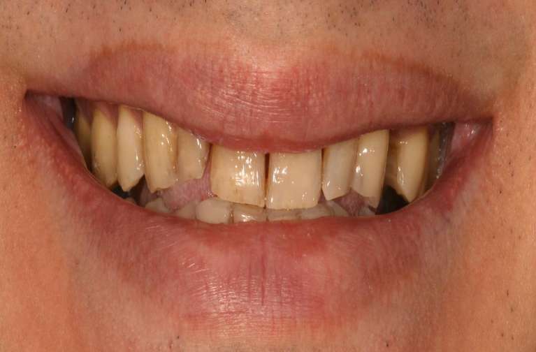 Dental-Implants-Before-Image