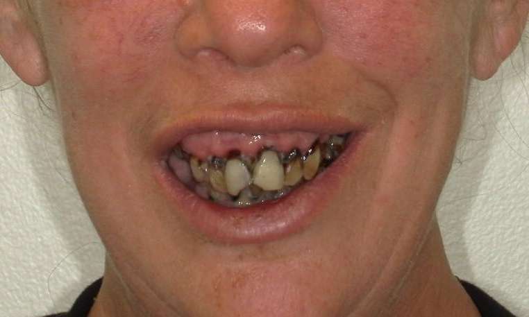Full-Mouth-Reconstruction-Before-Image