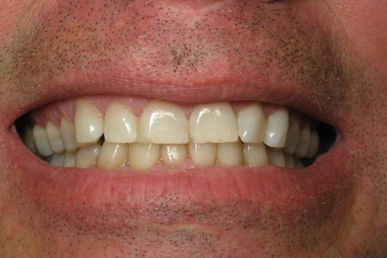 Crowns-and-Bridges-Before-Image