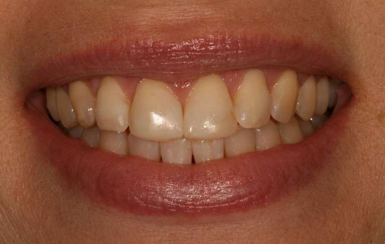 old dental work for a dated looking smile