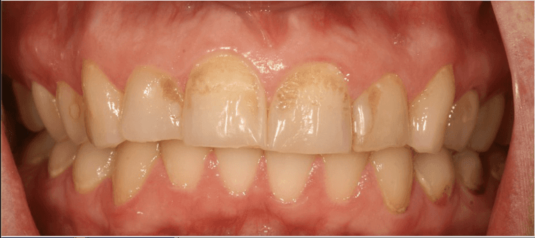 worn and yellowed front teeth