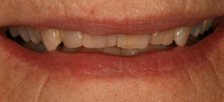 woman's worn front teeth