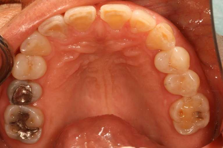 patient's top teeth with old metal fillings and some wear
