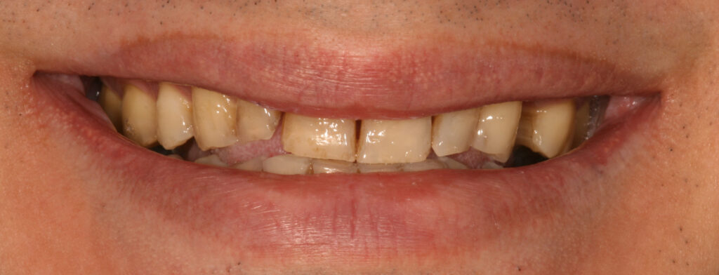 Before photo of a smile transformation, anonymous case 7