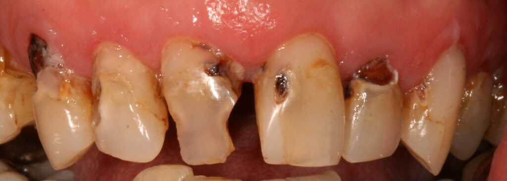 Before photo of a smile transformation, anonymous case 5