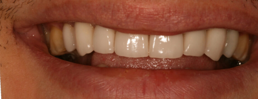 After photo of a smile transformation, anonymous case 7