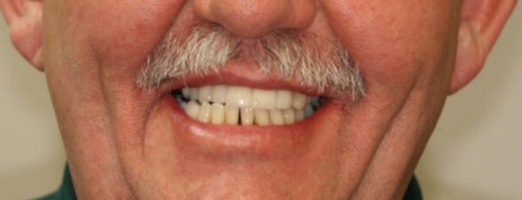 After photo of a smile transformation, anonymous case 6