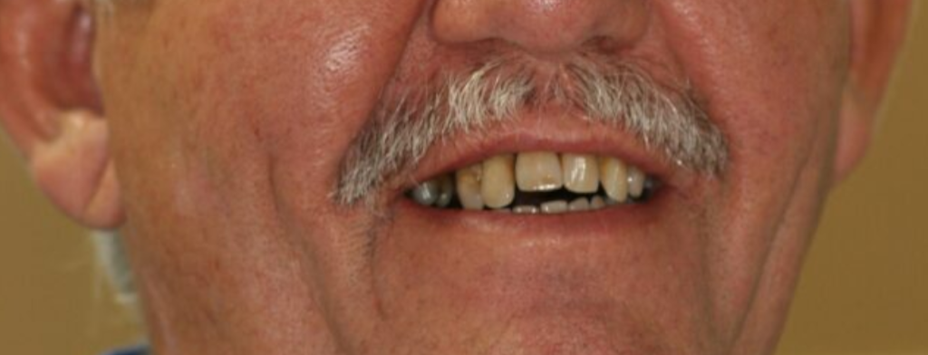 Before photo of a smile transformation, anonymous case 6