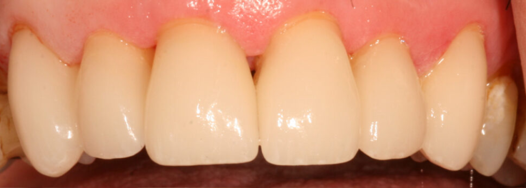 After photo of a smile transformation, anonymous case 5