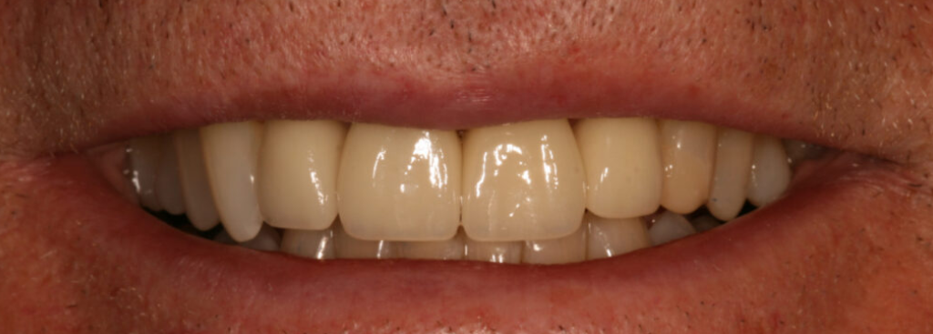 After photo of a smile transformation, anonymous case 4