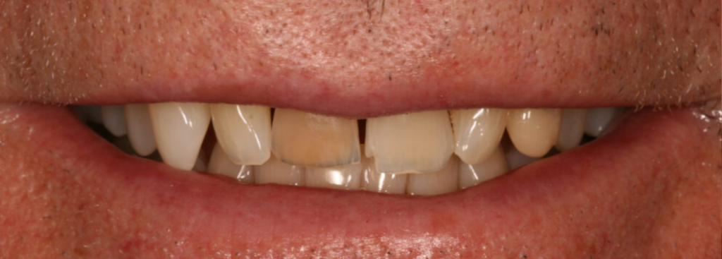 Before photo of a smile transformation, anonymous case 4