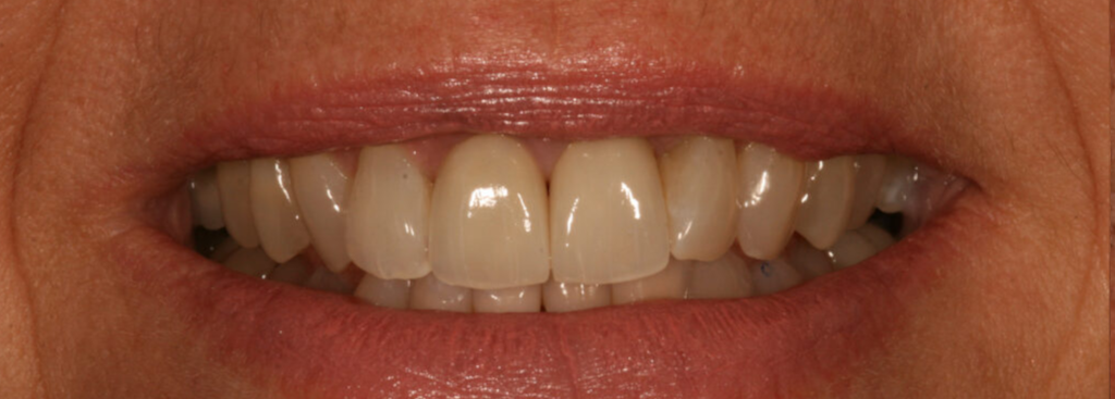 After photo of a smile transformation, anonymous case 3