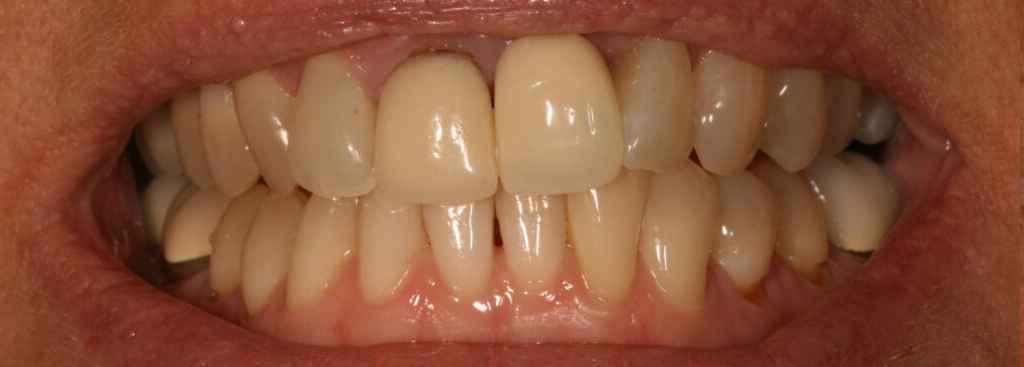 Before photo of a smile transformation, anonymous case 3