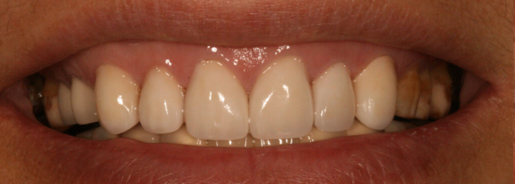 After photo of a smile transformation, anonymous case 2