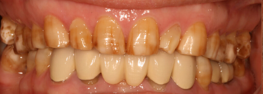 Before photo of a smile transformation, anonymous case 2