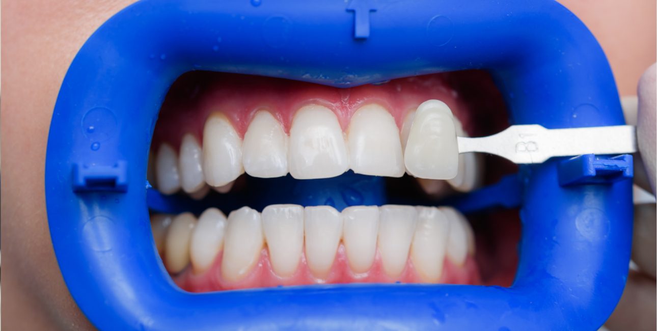 Professional teeth whitening treatment in progress
