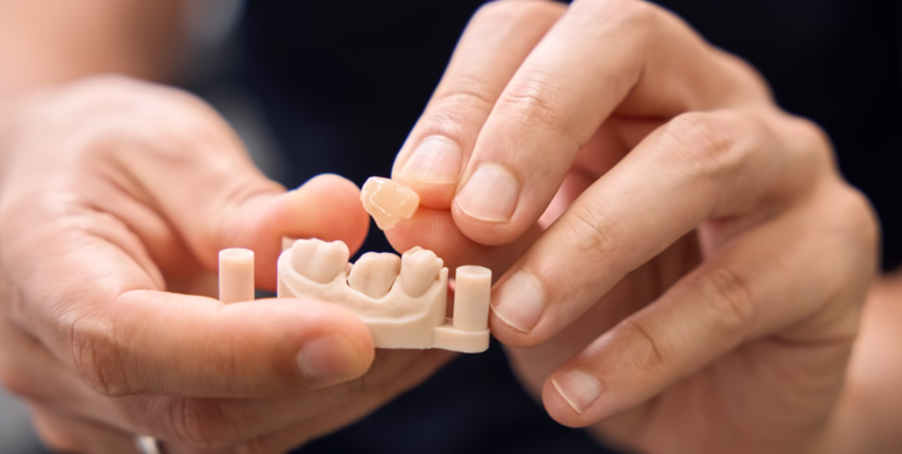 Dental crown and bridge restoration model